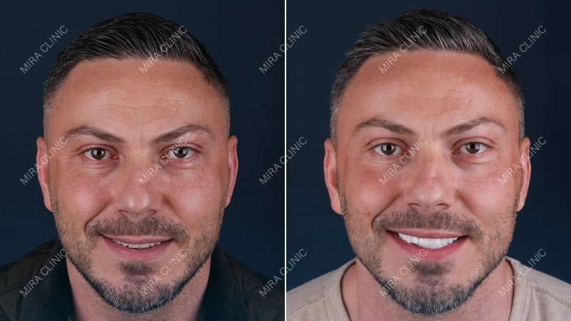 Dental implant patient review istanbul